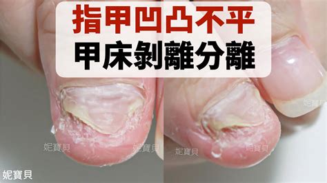 指甲分開|甲分離症：症狀、病因及如何治療